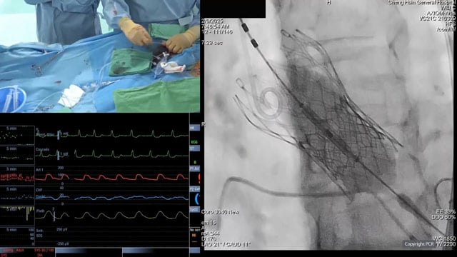 Transcatheter management of failed THV - LIVE case