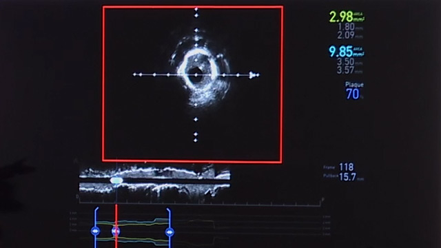 Contemporary approach in the treatment of calcified coronary artery disease 