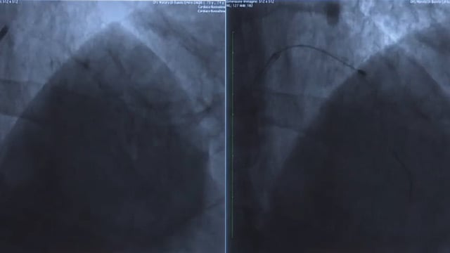 Drug-eluting balloon in calcified lesions and complex lesions