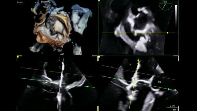 Innovation in action: achieving optimal outcomes in mitral regurgitation