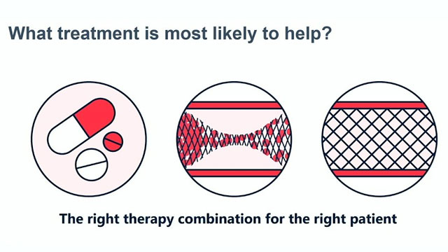 Evidence in action: advancing care for angina with Shockwave Reducer