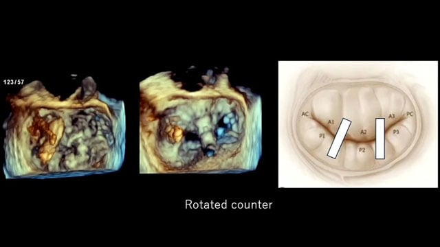 Advancing mitral transcatheter edge-to-edge repair in complex lesions