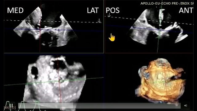Advancing mitral care with the Intrepid TMVR system