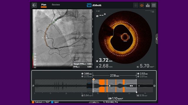 AI adoption in the cathlab of tomorrow - Intravascular imaging applications