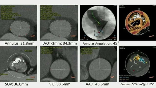Artificial intelligence-driven precision therapy for TAVI: progress and practice in China