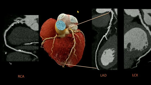 Artificial intelligence-powered precision: CT-guided PCI and the future of image-guided therapy