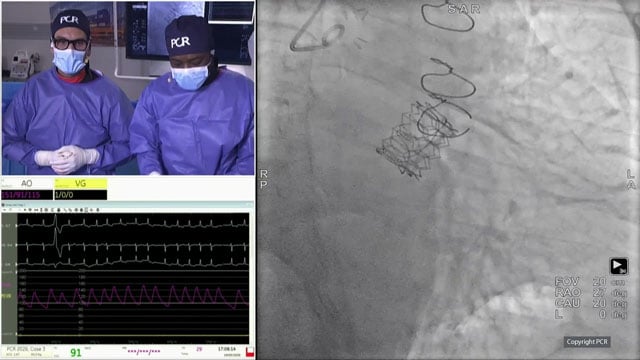 Align for the future with structural heart innovations - Live case and major trial updates