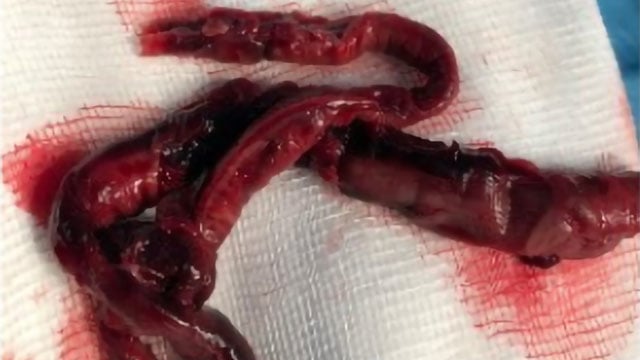 All you need to know about interventional therapies for pulmonary embolism