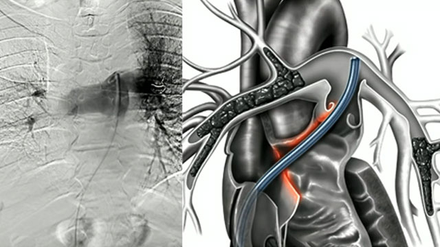 All you need to know about interventional therapies for pulmonary embolism