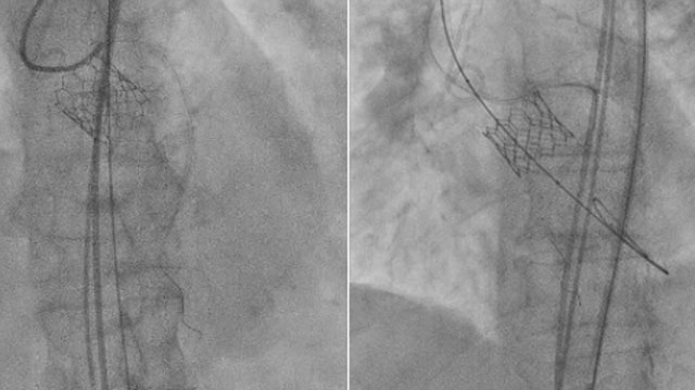 Antithrombotic therapy after TAVI: optimal agents, regimens, and patient selection