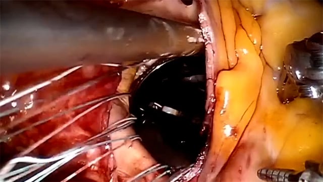 Aortic regurgitation in 2026