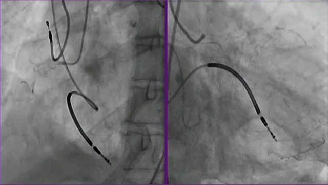 Best coronary complications