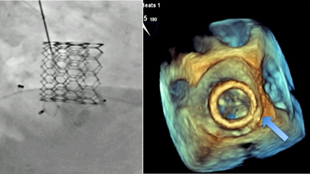 Best structural complications