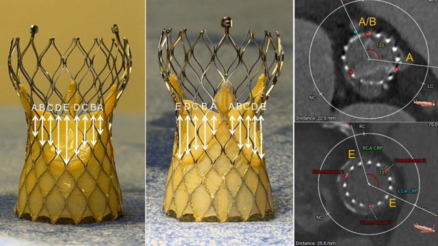 Beyond first implant: valve-in-valve, redo and leaflet modification