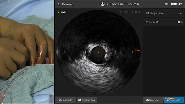 Calcified lesion of distal protected left main - LIVE case