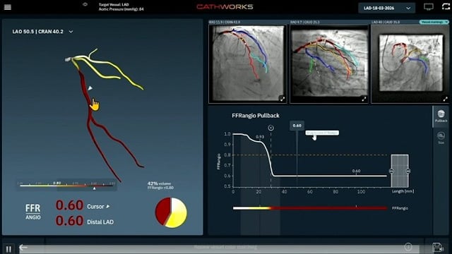 CathWorks FFRangio: from clinical data to advanced patient care