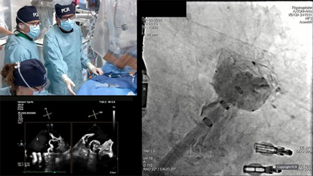 Combined mitral repair and LAA closure with two separate septal punctures - LIVE case