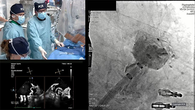 Combined mitral repair and LAA closure with two separate septal punctures - LIVE case