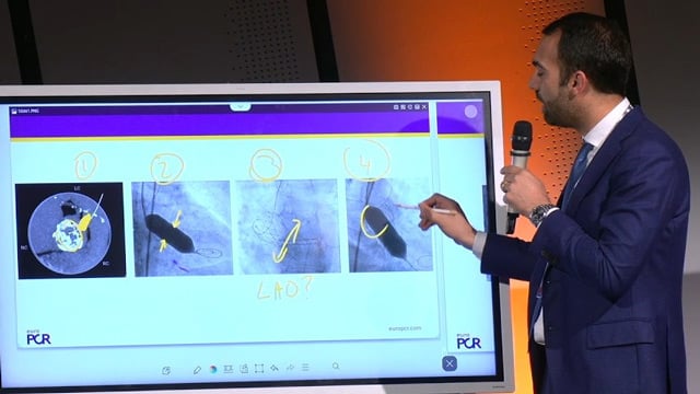 Mastering complex TAVI: achieving optimal outcomes with Evolut FX+