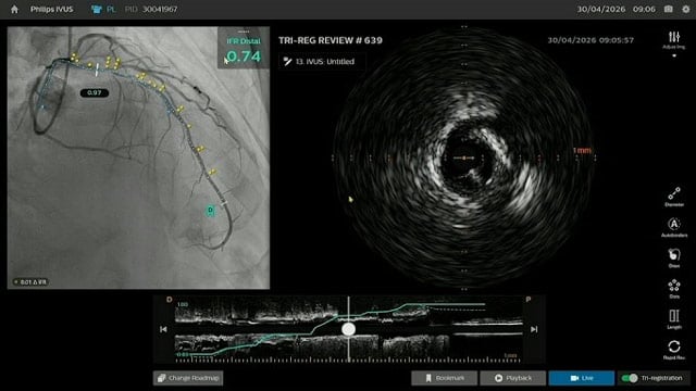 Contemporary workflow for class IA PCI