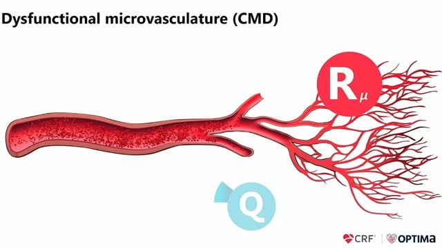 Early evidence from a next generation coronary sinus reducer for the treatment of coronary microvascular dysfunction