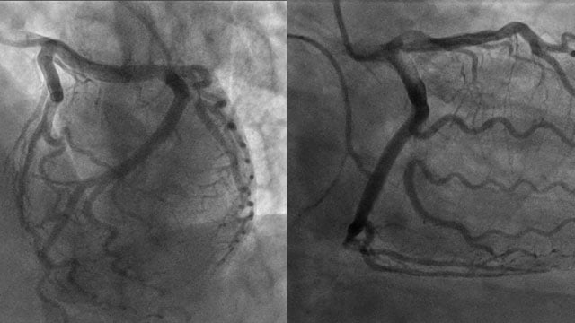 Dangers of dissection: the role of ICI