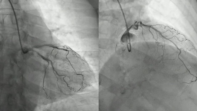 DCB: does coating morphology matter for distal embolisation and clinical outcomes?
