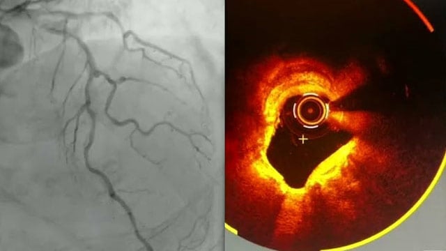 DCB in contemporary PCI: evidence, technique and physiology-guided decision-making