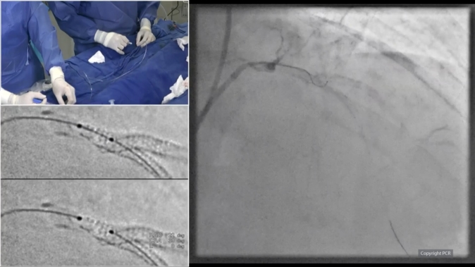 DK crush technique in a calcified LAD-diagonal bifurcation - LIVE case