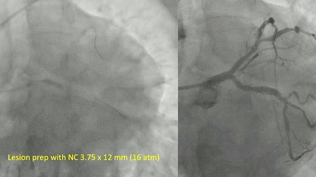 Evolving bifurcation treatment practices: DCB, angio-based FFR and side branch optimisation