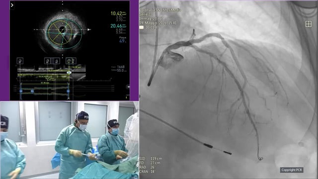 FFR- and IVUS-guided PCI of a long and calcified LAD lesion - LIVE case