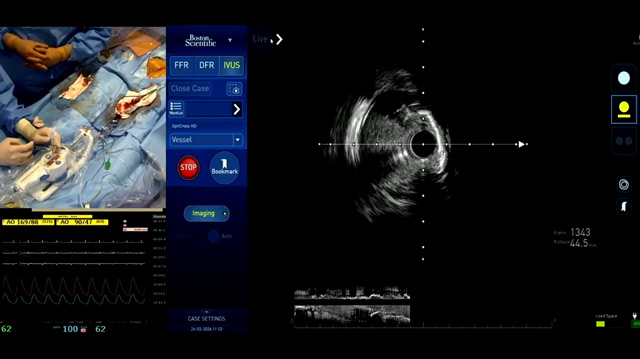 High definition IVUS-guided treatment strategies in calcified stenoses