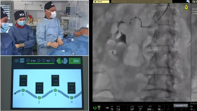 IBERIS: the first radial renal denervation (RDN) system for the treatment of uncontrolled hypertension