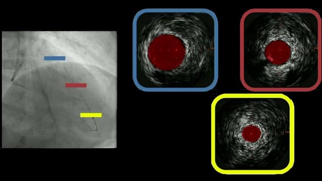 Remaining challenges and role of innovative DES technology in complex PCI