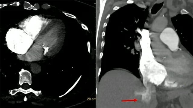 Landmark interventional randomised controlled trial data and practice guidelines to transform pulmonary embolism care