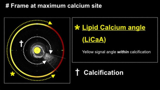 Intracoronary imaging evaluation of stent implantation