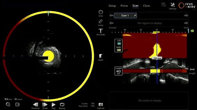 IVUS and NIRS imaging: a pathway to improve outcomes in stable and acute coronary syndromes