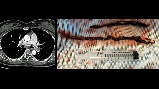 Large-bore thrombectomy in pulmonary embolism practice: when intervention matters