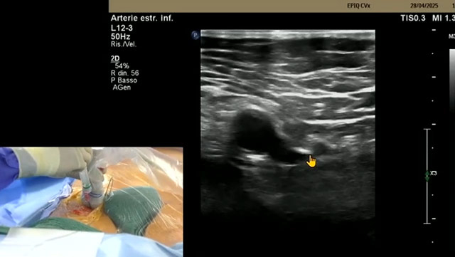 Large-bore venous access and vessel closure: all you need to know