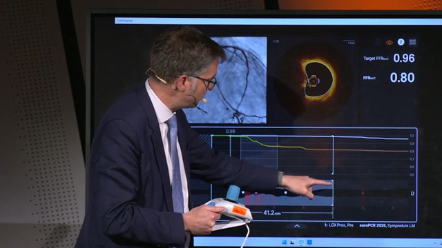Left main PCI treatment: how Ultreon 3.0 can improve decision making and achieve optimised outcomes