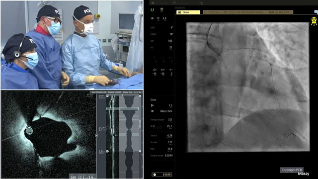 Left main and complex bifurcation stenting