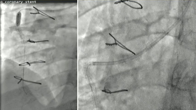Lost, crushed, fractured: stent complications in real life