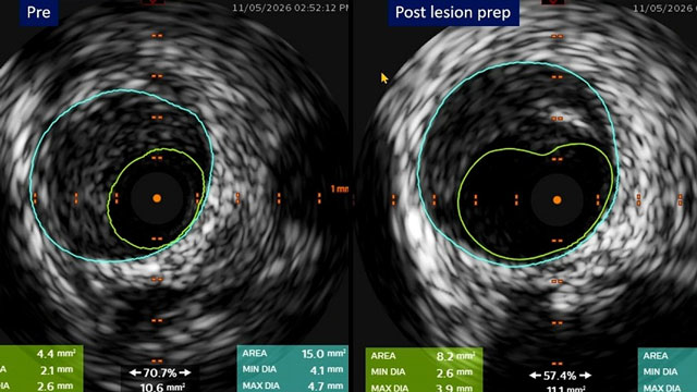 MagicTouch sirolimus-coated balloon for coronary artery disease and peripheral artery disease treatment: where evidence meets experience