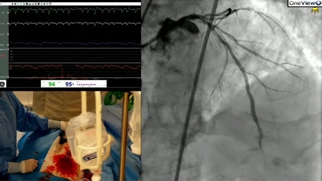 Navigating high-thrombus burden in ACS: precision aspiration thrombectomy with CAT RX