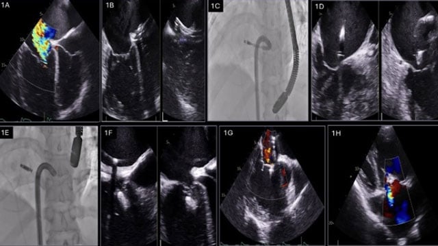 Other valvular and structural interventions