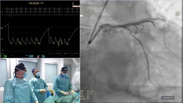 PCI of calcified distal left main stenosis - LIVE case