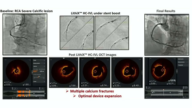 Breaking the calcium challenge: the power of Hertz with LithiX intravascular lithotripsy