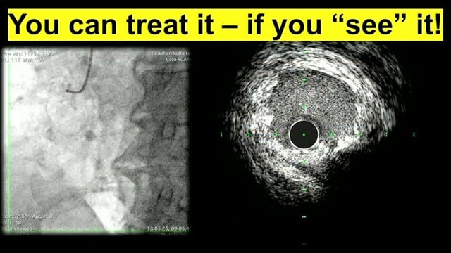 From angiography to precision PCI: integrating ACIST Pro contrast management system and high-definition IVUS imaging