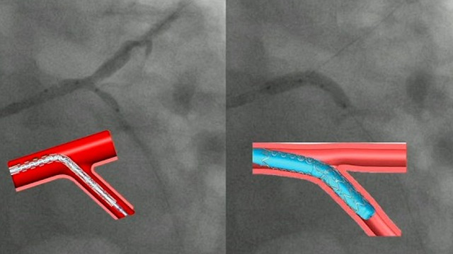 PRISM-PCI - From clarity to cure