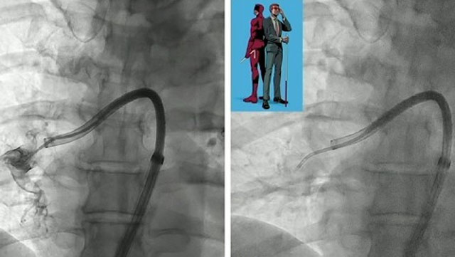 From access to reperfusion: a procedural deep dive into pulmonary embolism